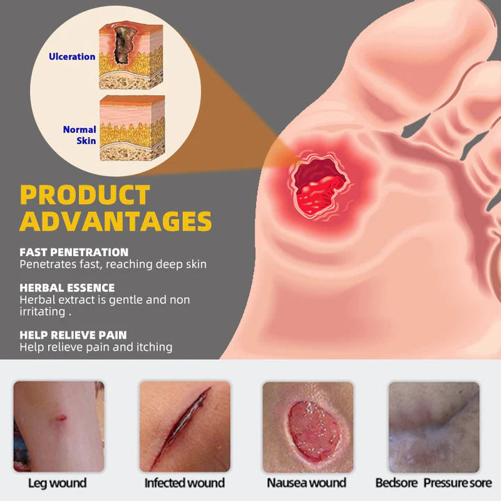 Bedsore cream-Decubitus ulcer treatment cream to solve your worriesđ„