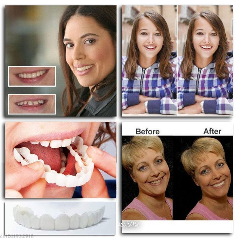 👨⚕Adjustable Snap-On Dentures😁100% non-inductive fit, no foreign body sensation!😁 (💥45% OFF) - 🔥HOT SALE🔥🎉